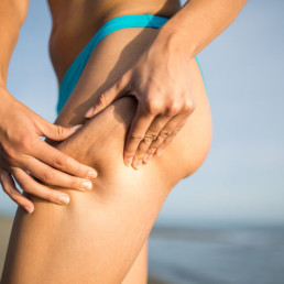 cellulite