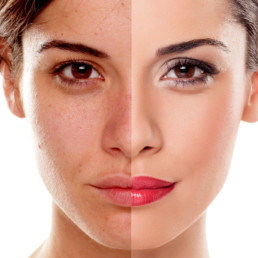 acne e peeling chimico