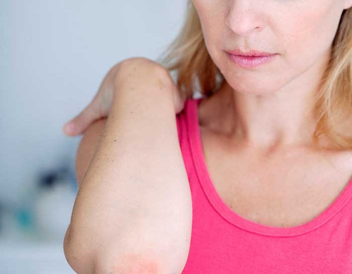 Scopri di più sull'articolo Psoriasi