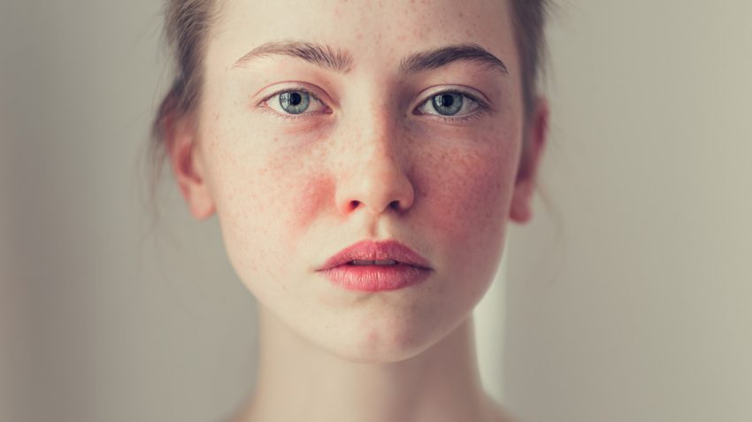 Scopri di più sull'articolo Rosacea: una nuova spia di allarme?