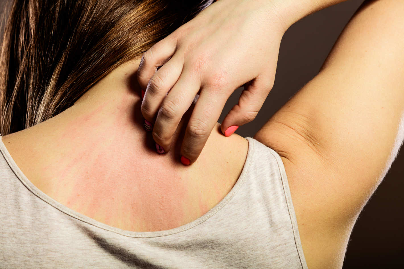 Al momento stai visualizzando Dermatite atopica