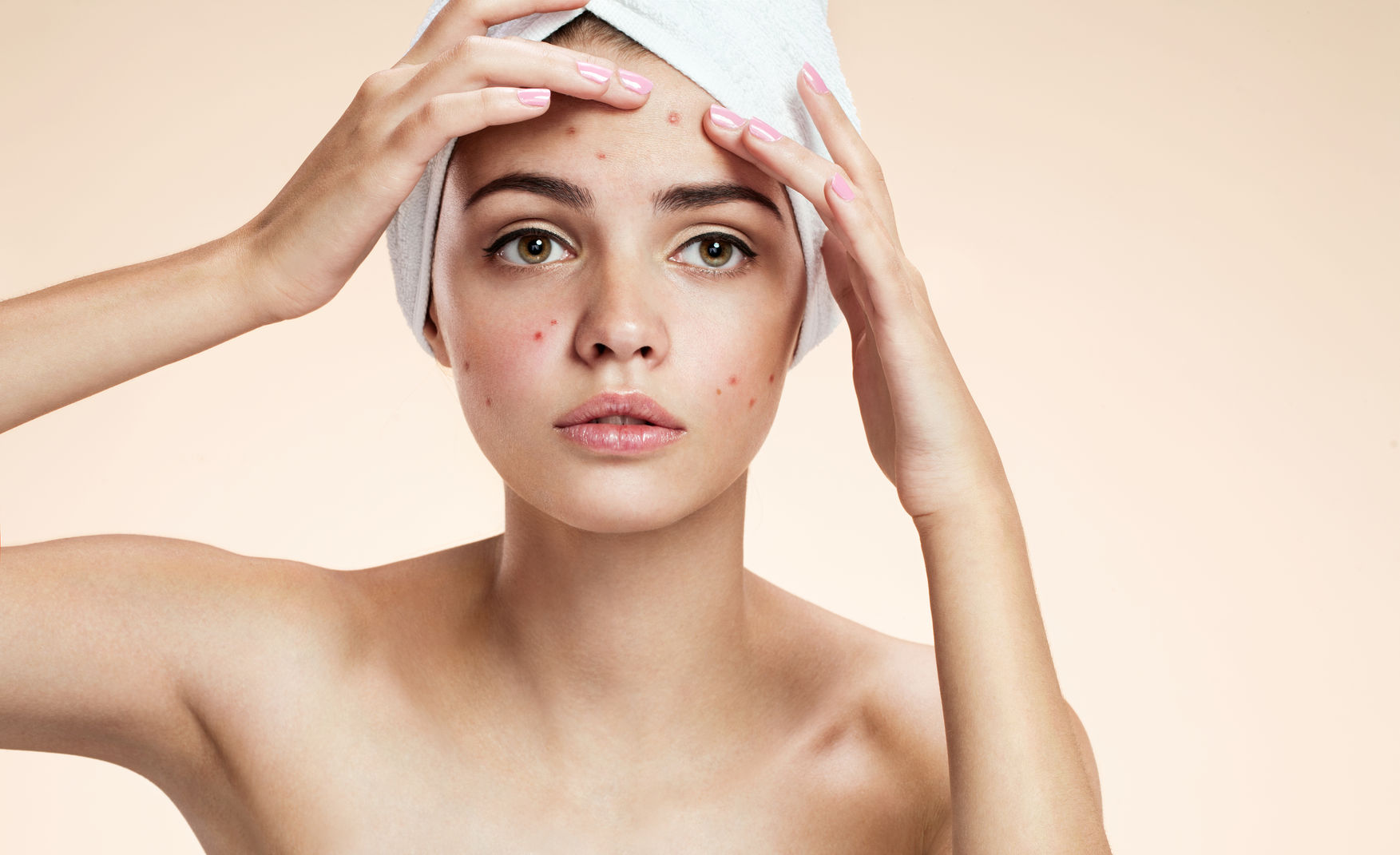 Scopri di più sull'articolo Acne