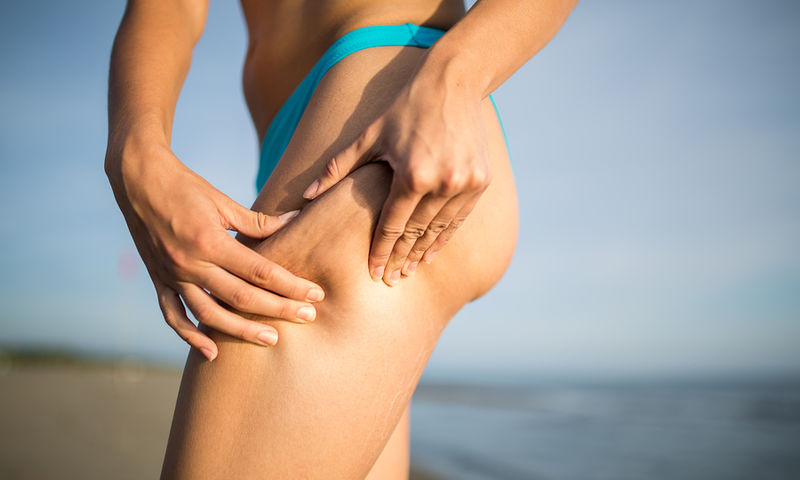 Al momento stai visualizzando Cellulite