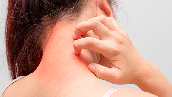 Al momento stai visualizzando Terapia della dermatite atopica di grado lieve e moderato in età pediatrica